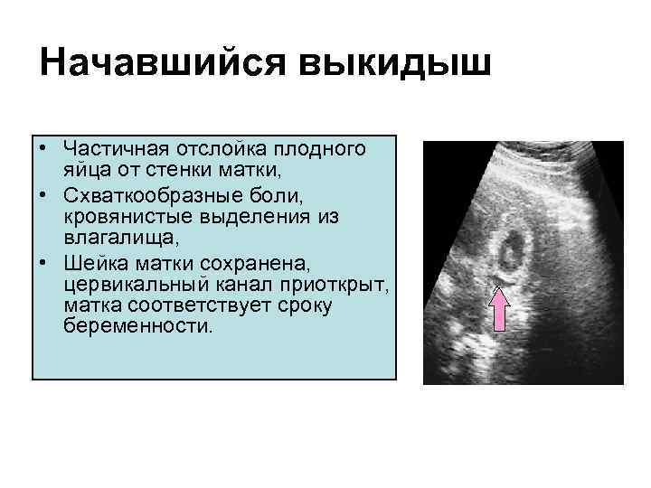 Причины выкидыша на ранних сроках беременности