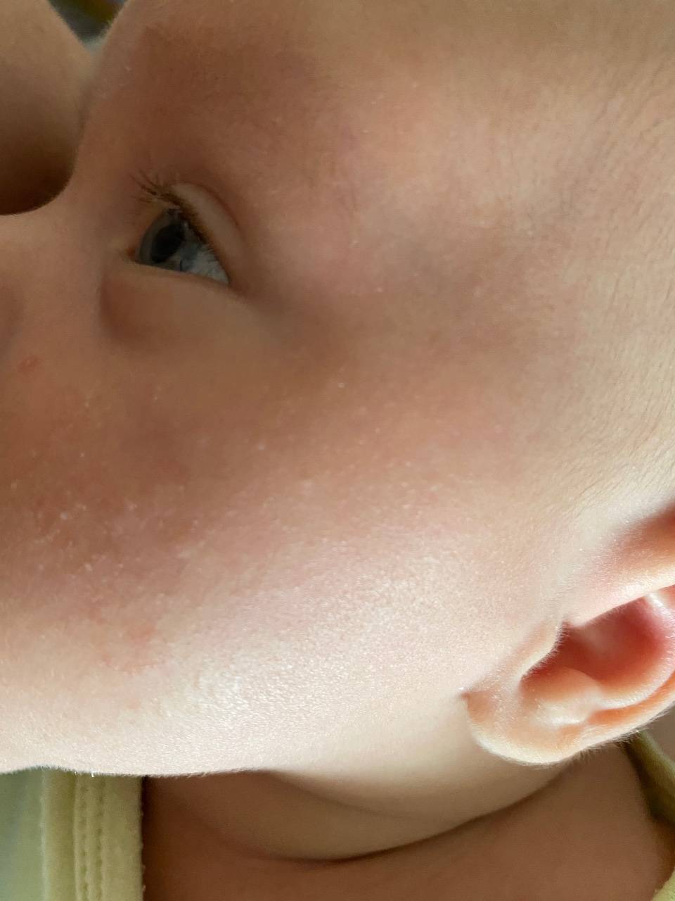 Крапивница у детей: симптомы, лечение | как выглядит крапивница у ребенка, фото