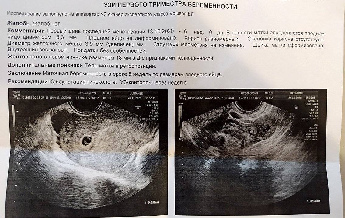 Когда на узи видно эмбрион: исследование в 5-6 недель беременности