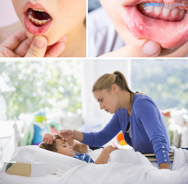 Афтозный стоматит у детей: лечение и симптомы заболевания с фото во рту