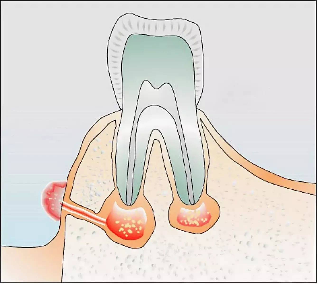 Температура после лечения зуба. Свищевой ход периодонтит. Передонтит свешевой вход. Гранулирующий периодонтит свищевой ход.