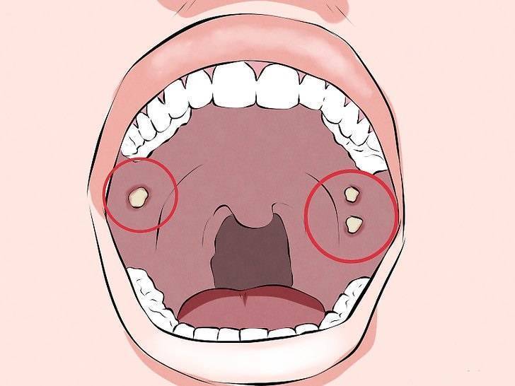 Заболевания полости рта при covid-19: разновидности, лечение