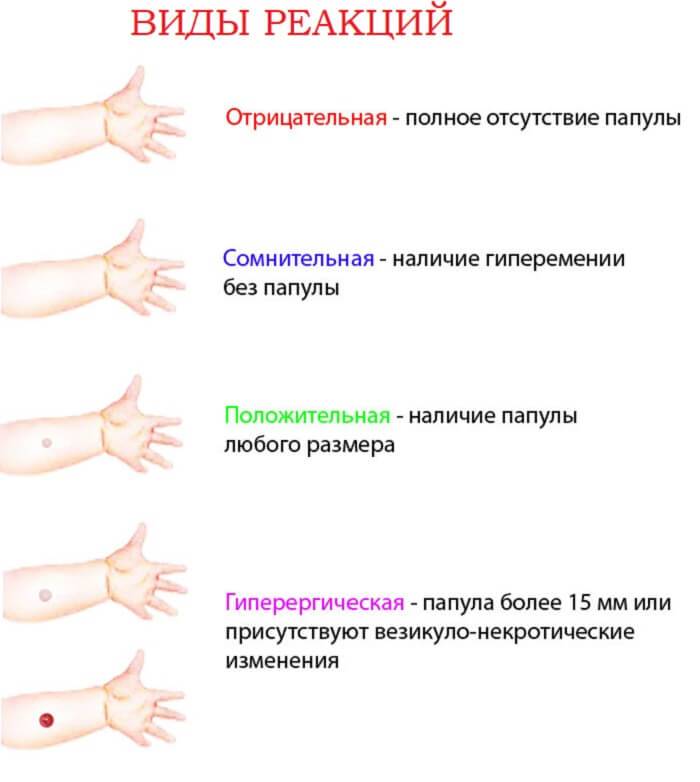 Проведение пробы манту