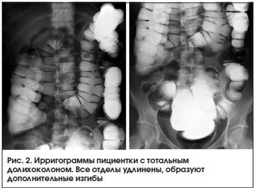 Долихосигма кишечника у ребенка: симптомы у детей, причины, лечение - medboli.ru