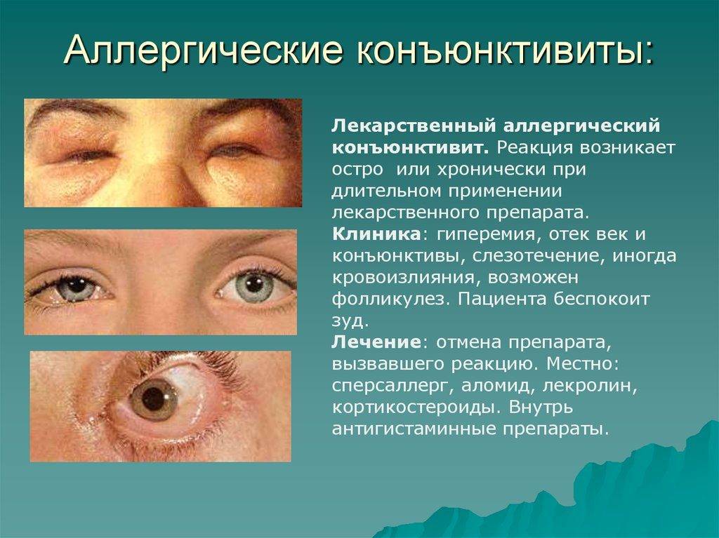 Конъюнктивит у детей - причины, симптомы, лечение и профилактика