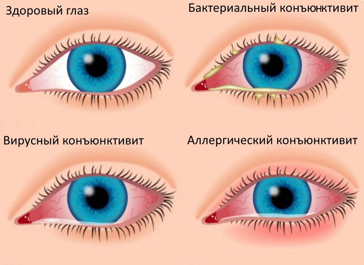Вирусные конъюнктивиты у детей: особенности течения и лечения | nasdr