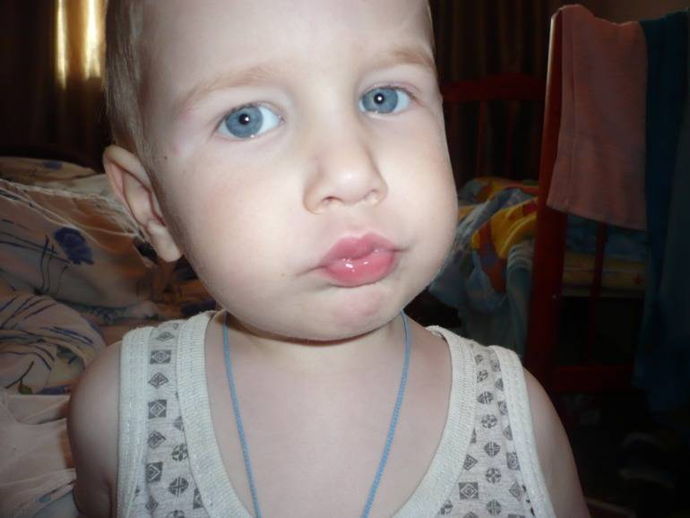 У ребенка опухла губа: причины, сопутствующие симптомы и лечение