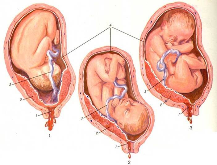 Низкая плацентация при беременности | аборт в спб