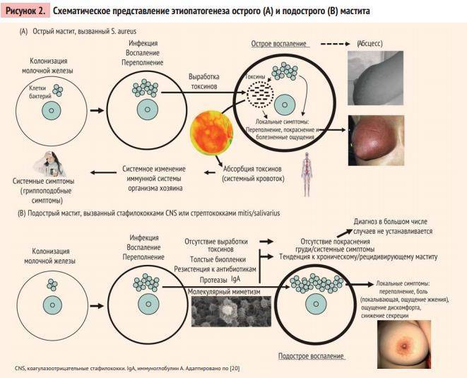Все про гинекомастию у мужчин – симптомы, причины, лечение, операция и стоимость