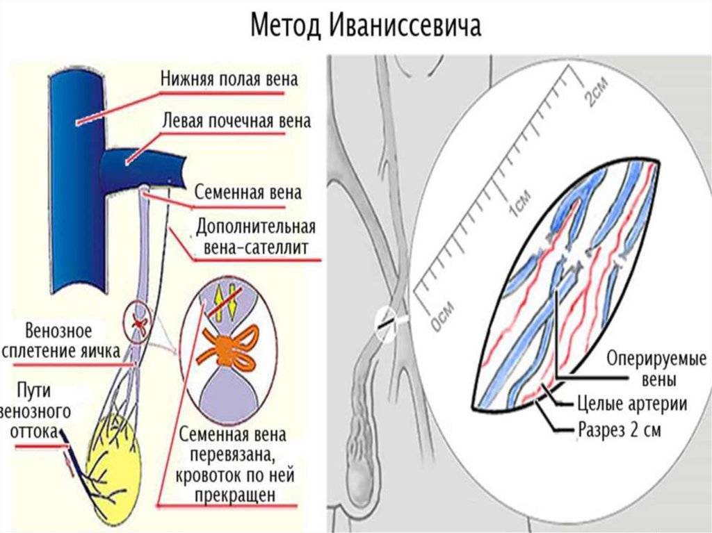 Медикаментозное лечение варикоцеле