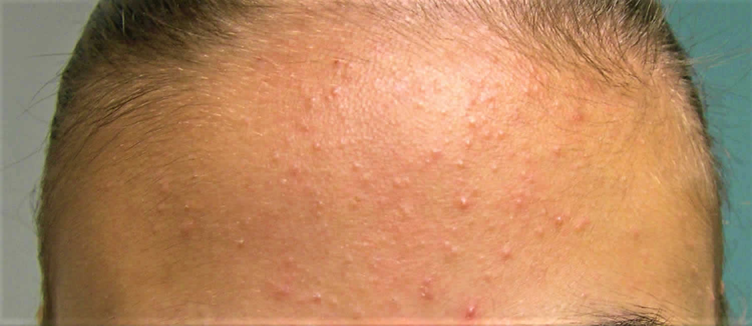Аллергия на коже лица: виды аллергической сыпи у взрослого, лечение и фото, чем лечить, снять реакцию, что делать с прыщами, как убрать и избавиться, причины сильных высыпаний на шее