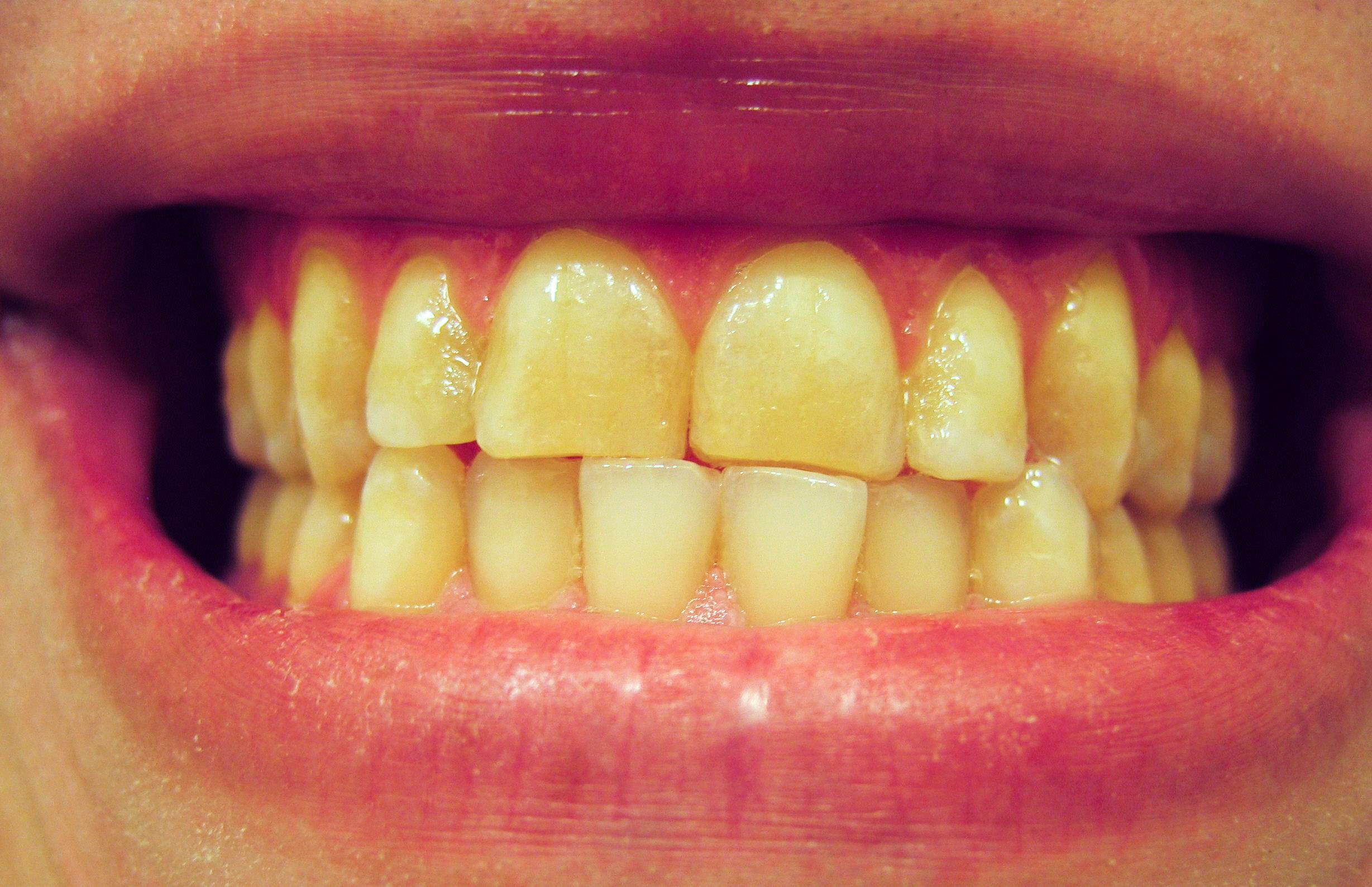 Желтые зубы