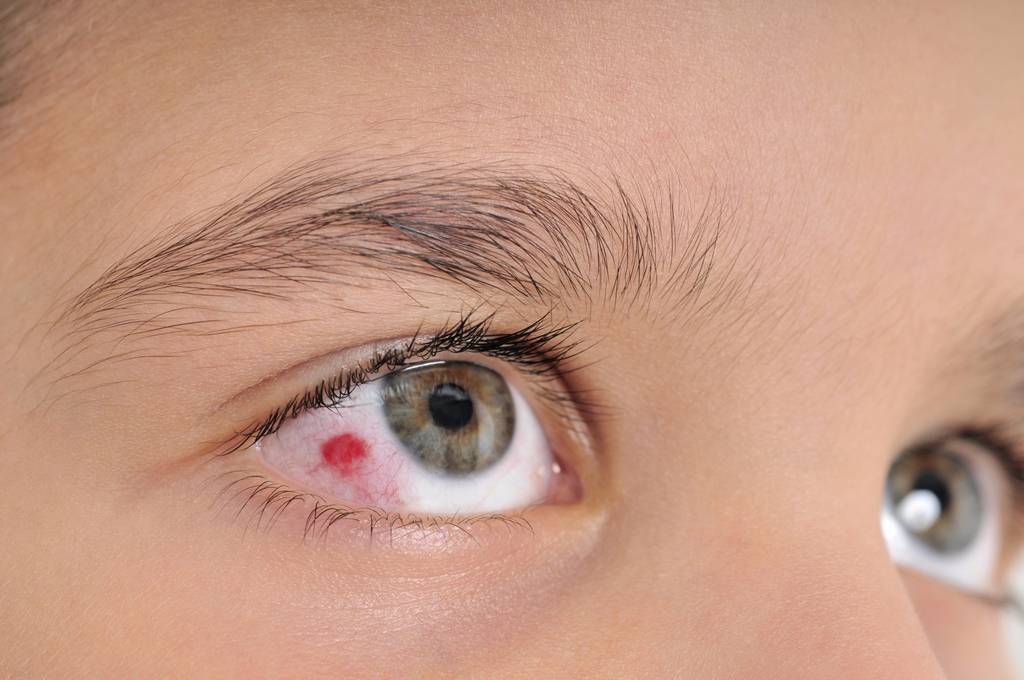 Что делать, если у ребенка лопнул сосуд в глазу, в чем причины повреждения капилляров?