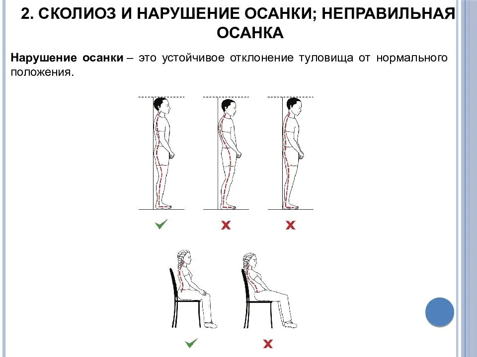 Профилактика сколиоза презентация