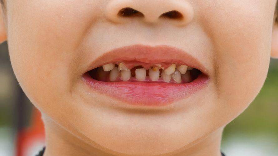 Кариес у детей | лечение и профилактика раннего кариеса молочных зубов