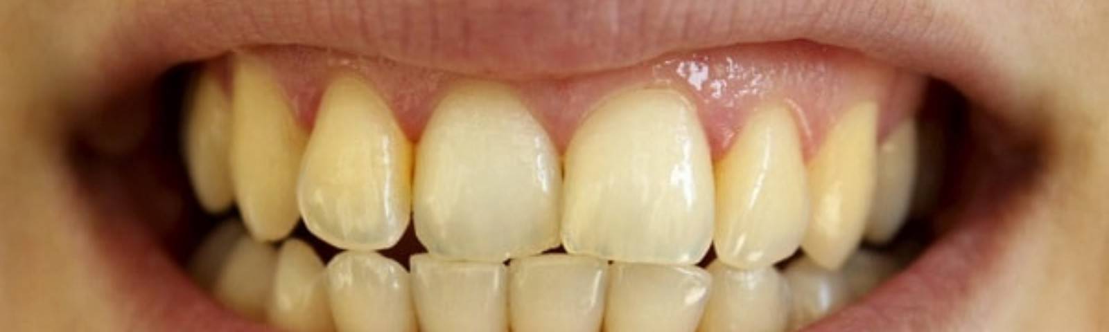 Виды зубного налёта и способы его удаления