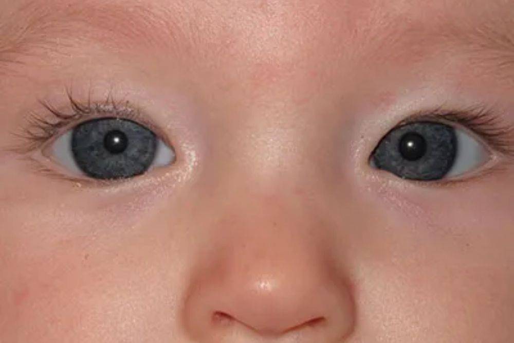 Когда у новорожденных и грудничков проходит косоглазие, почему у ребенка косят глазки?