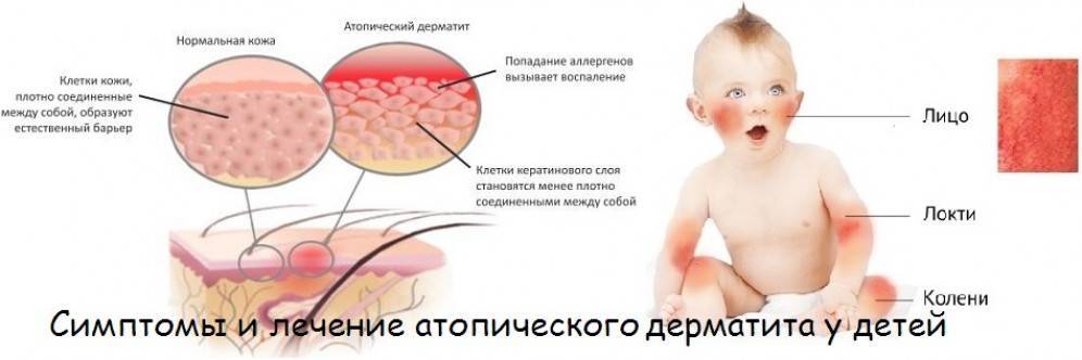 Атопический дерматит у детей - симптомы болезни, профилактика и лечение атопического дерматита у детей, причины заболевания и его диагностика на eurolab