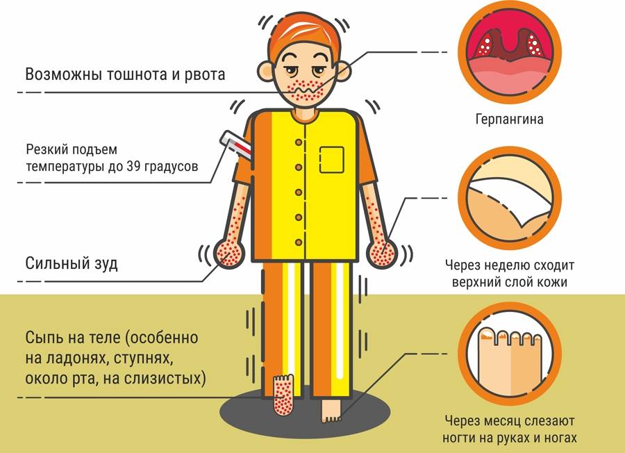 Турецкий грипп симптомы и лечение у детей фото