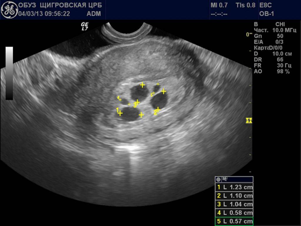 Когда виден эмбрион в плодном яйце. УЗИ признаки маточной беременности. Плодное яйцо 7 недель на УЗИ В матке. Остатки плодного яйца в полости матки УЗИ.