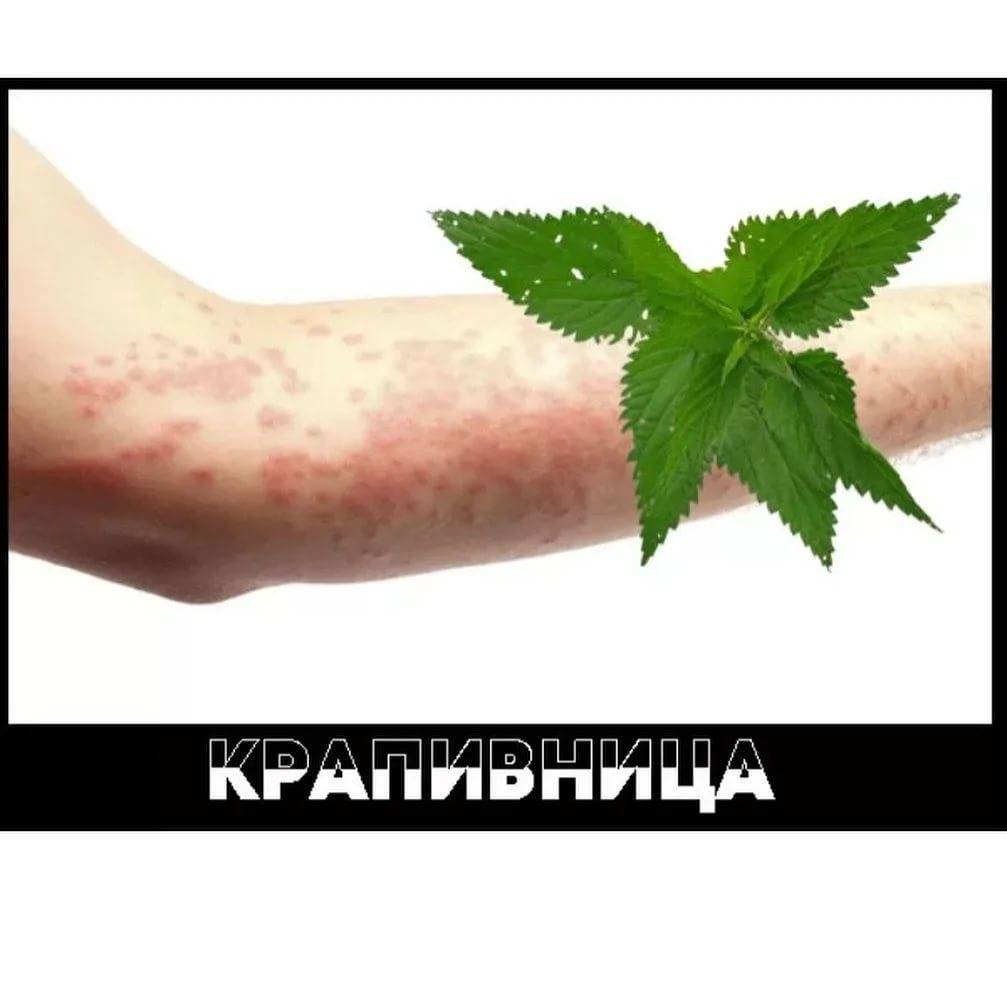 Аллергическая крапивница - лечение у взрослых и детей