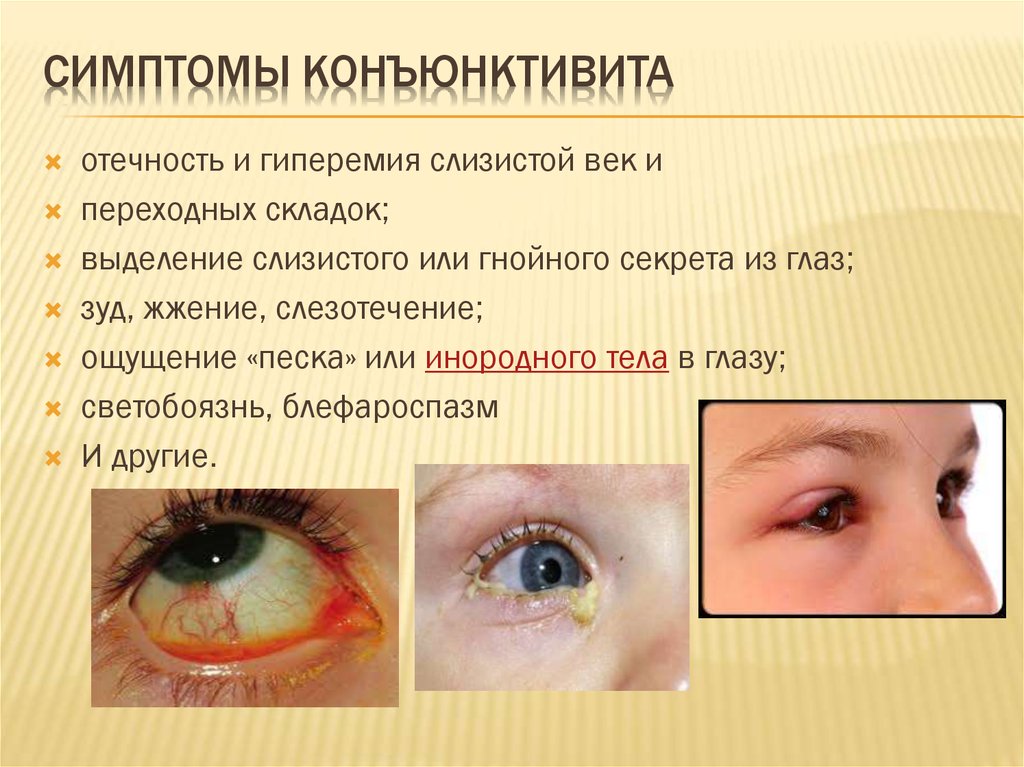 Аденовирусный конъюнктивит у детей - симптомы и лечение заболевания глаз