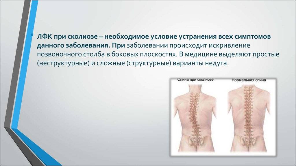Сколиозы позвоночника