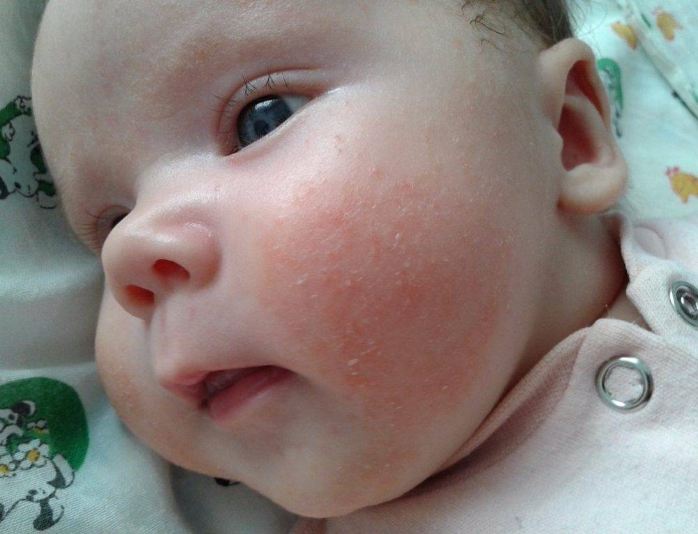 Аллергия на солнце у малыша