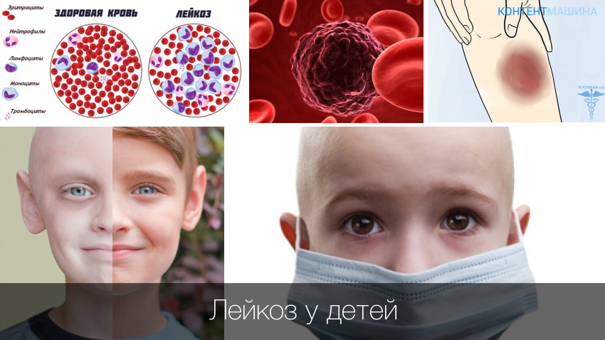 Cимптомы лейкоза у детей: первые признаки и причины болезни