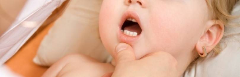 Молочница во рту у грудничка и новорожденного: причины и лечение, профилактика, мнение комаровского