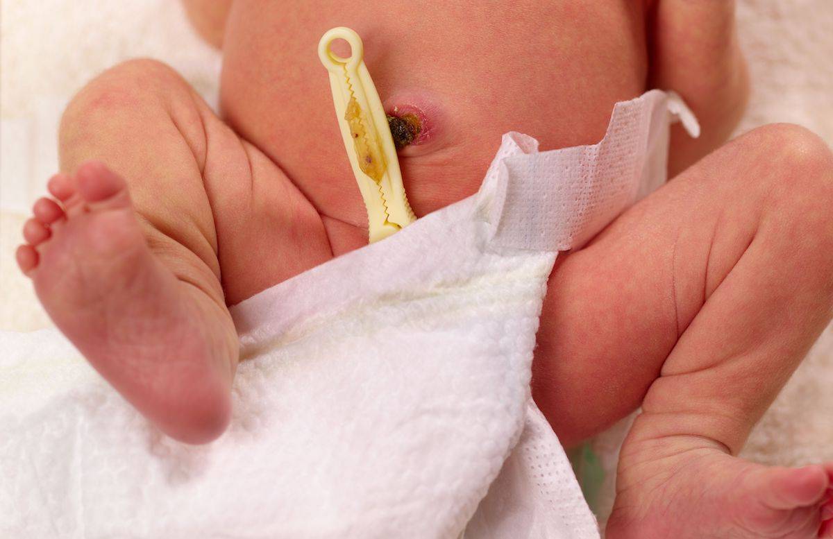 У новорожденного кровит пупок: что делать? как правильно обрабатывать пупок у новорожденного? почему мокнет и кровит пупок у новорожденных?