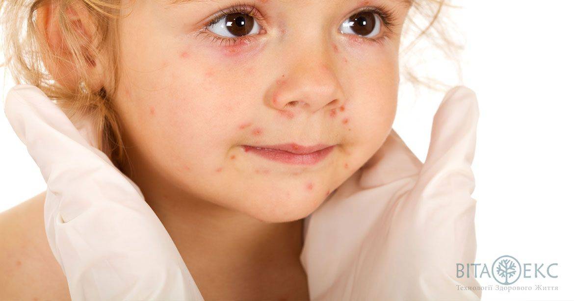 Герпес у детей - диагностика и лечение в спб | детский дерматолог см-клиника