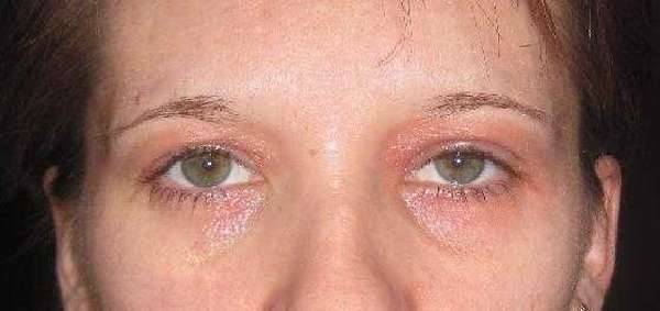 Аллергия на лице у взрослых и детей: причины, симптомы, лечение аллергии кожи лица