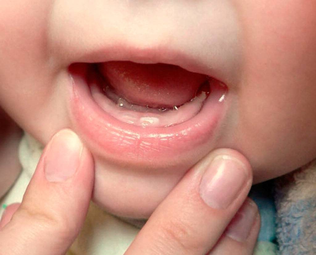 Прорезывание зубов у детей - сроки, порядок | «мистодентал plus»