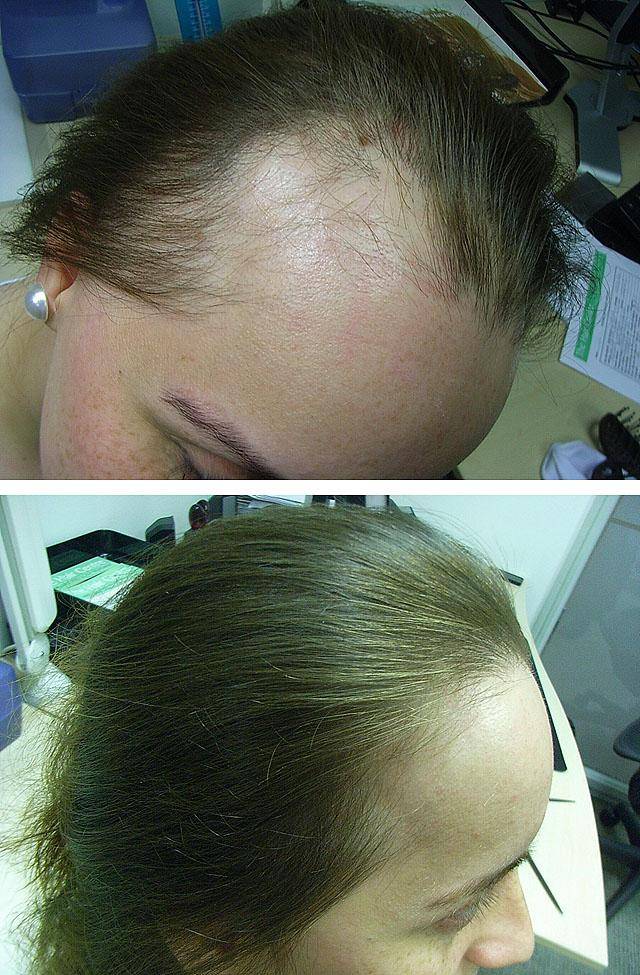 Выпадение волос: какие заболевания вызывают облысение?
