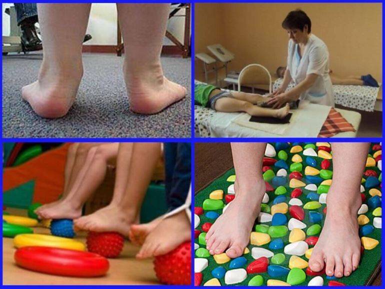Варусная деформация стопы у детей ???? - фото и симптомы, способы лечения, подбор обуви