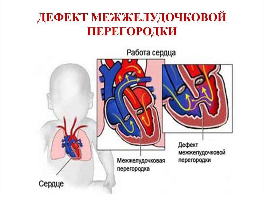 Врожденный порок сердца (впс) это, причины, лечение врожденного порока сердца