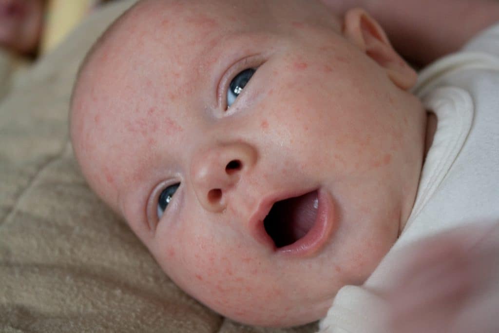 Аллергия на лице - лечение аллергической сыпи у взрослых: виды и чем лечить