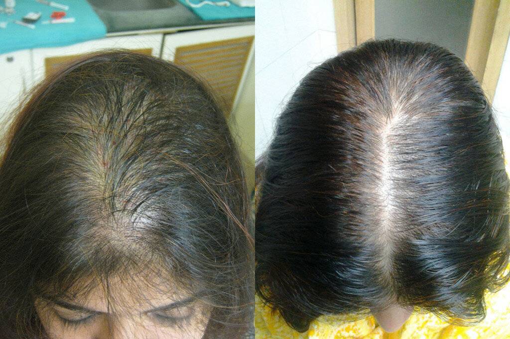 Сильное лечение волос. Волосы после облысения. Выпадение волос алопеция у женщин.