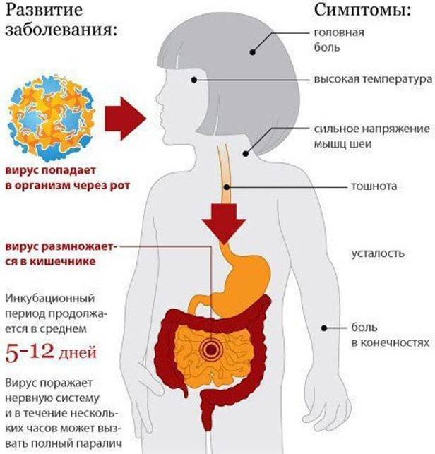 Полиомиелит: причины. формы и симптомы полиомиелита. профилактика полиомиелита – вакцинация