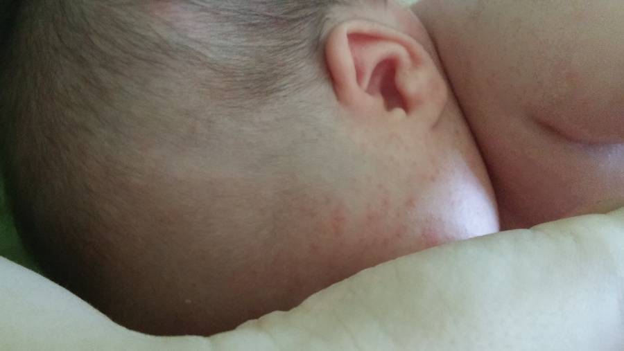 Потница или аллергия — отличия заболеваний