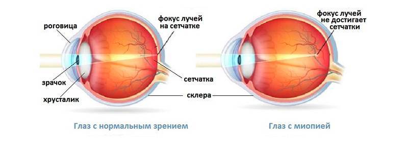 Склеропластика глаз у детей: подготовка к операции, как проводится, восстановление
