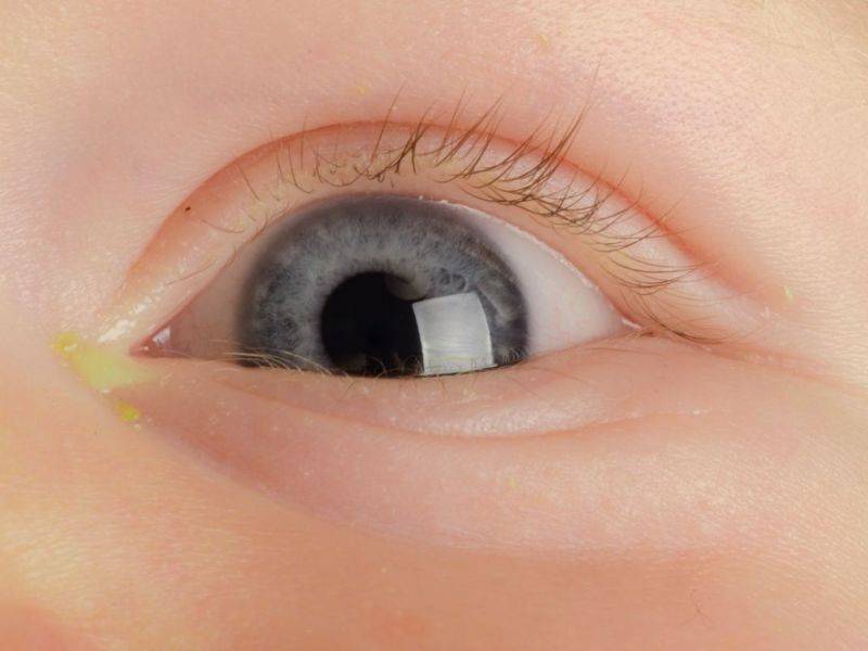 Гноится глаз у новорожденного - что делать, как и чем правильно лечить?