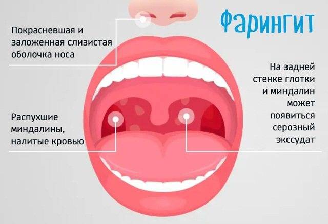 Герпесная ангина (лечение, симптомы), как лечится герпетическая ангина