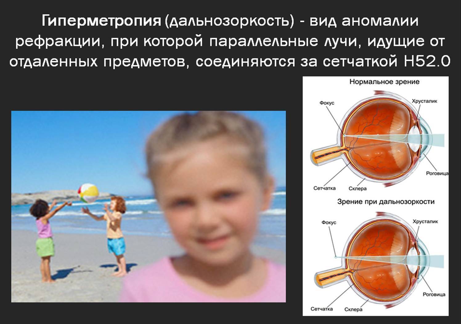 Гиперметропия высокой степени обоих глаз у детей: что это такое и чем отличается от слабой и средней