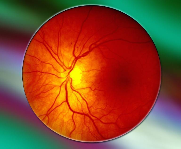 Ангиопатия сетчатки глаз: причины, симптомы, лечение