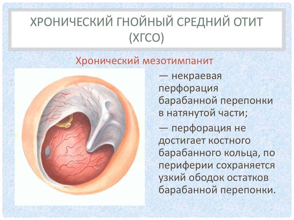 Лабиринтит (отит внутреннего уха)