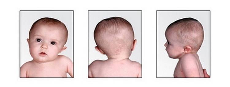 Увеличение окружности головы (макроцефалия) у ребенка: причины, проявление, диагностика, лечение