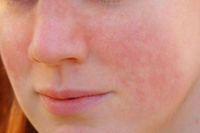 Аллергия на щеках у детей – причины, симптомы и лечение аллергии на щеках у ребенка