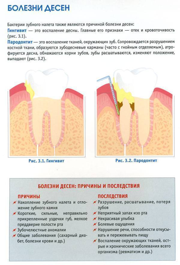 Воспалилась десна после удаления зуба: причины и лечение, как снять воспаление